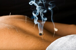 Moxibustion Warming Moxa on Acupuncture Needle During Treatment